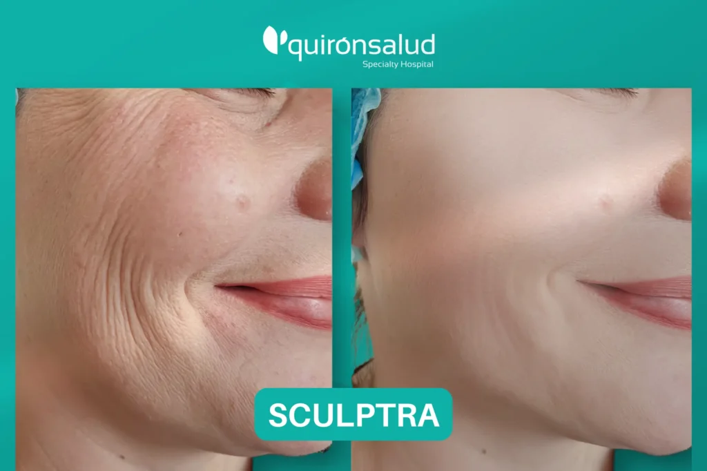 scalptra